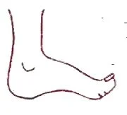 foot pain treatment silver spring sports medicine podiatrist
