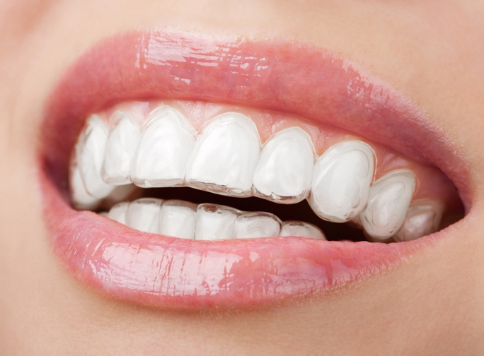 Clear removable plastic retainer