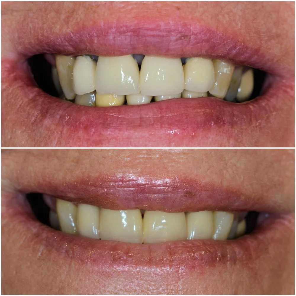 SMILRE BEFORE AFTER WEBSITE.jpg