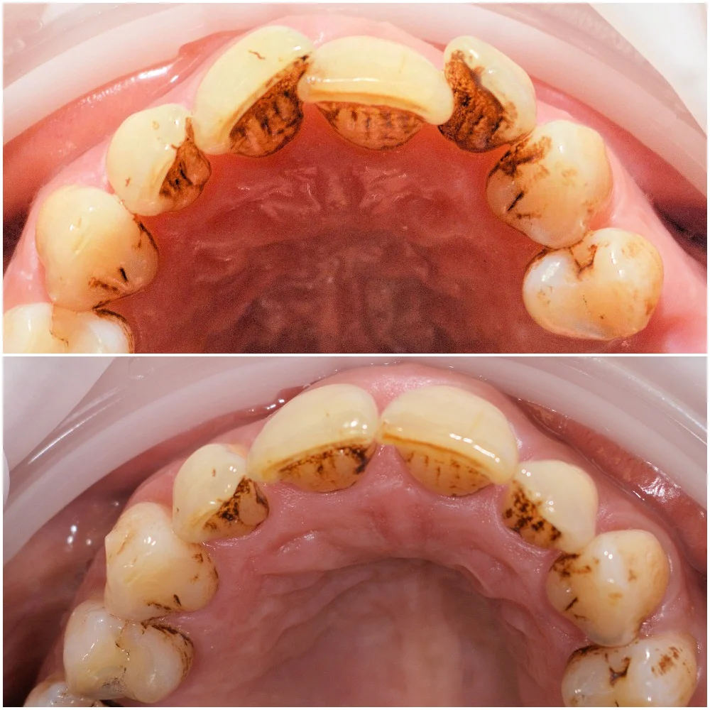beforeafter occlussal.jpg