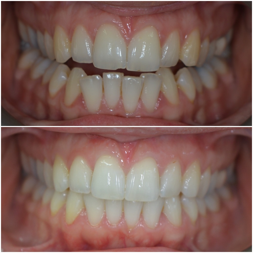 CT before after retracted.jpg