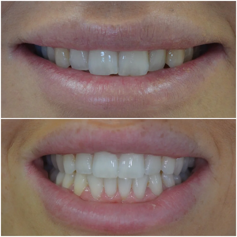 CT before and after smile.jpg