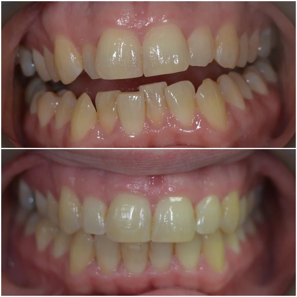 HA before after retracted.jpg