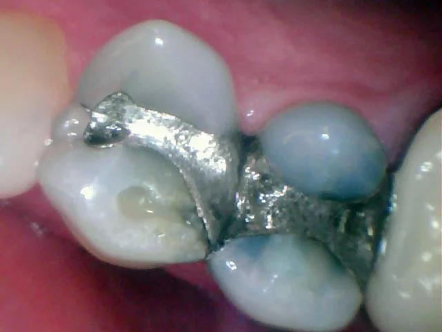 Plymouth, MN Dentist on Replacing Metal Fillings