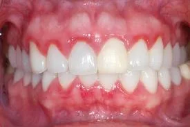 Teeth Cleanings Explained by Plymouth, MN Dentist