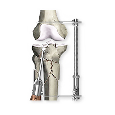 Fracture Care