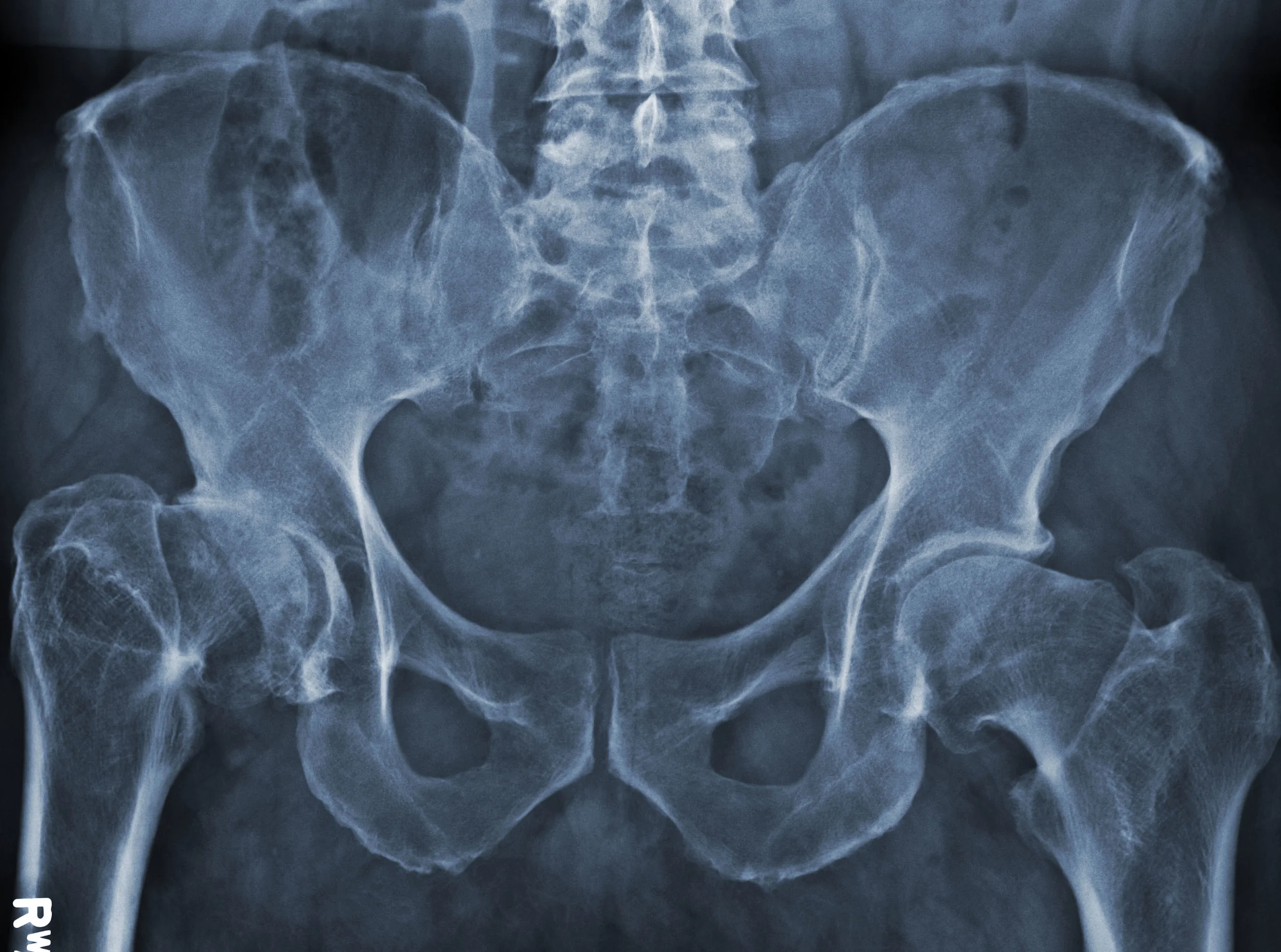 Arthritis & Post Traumatic Joint Care