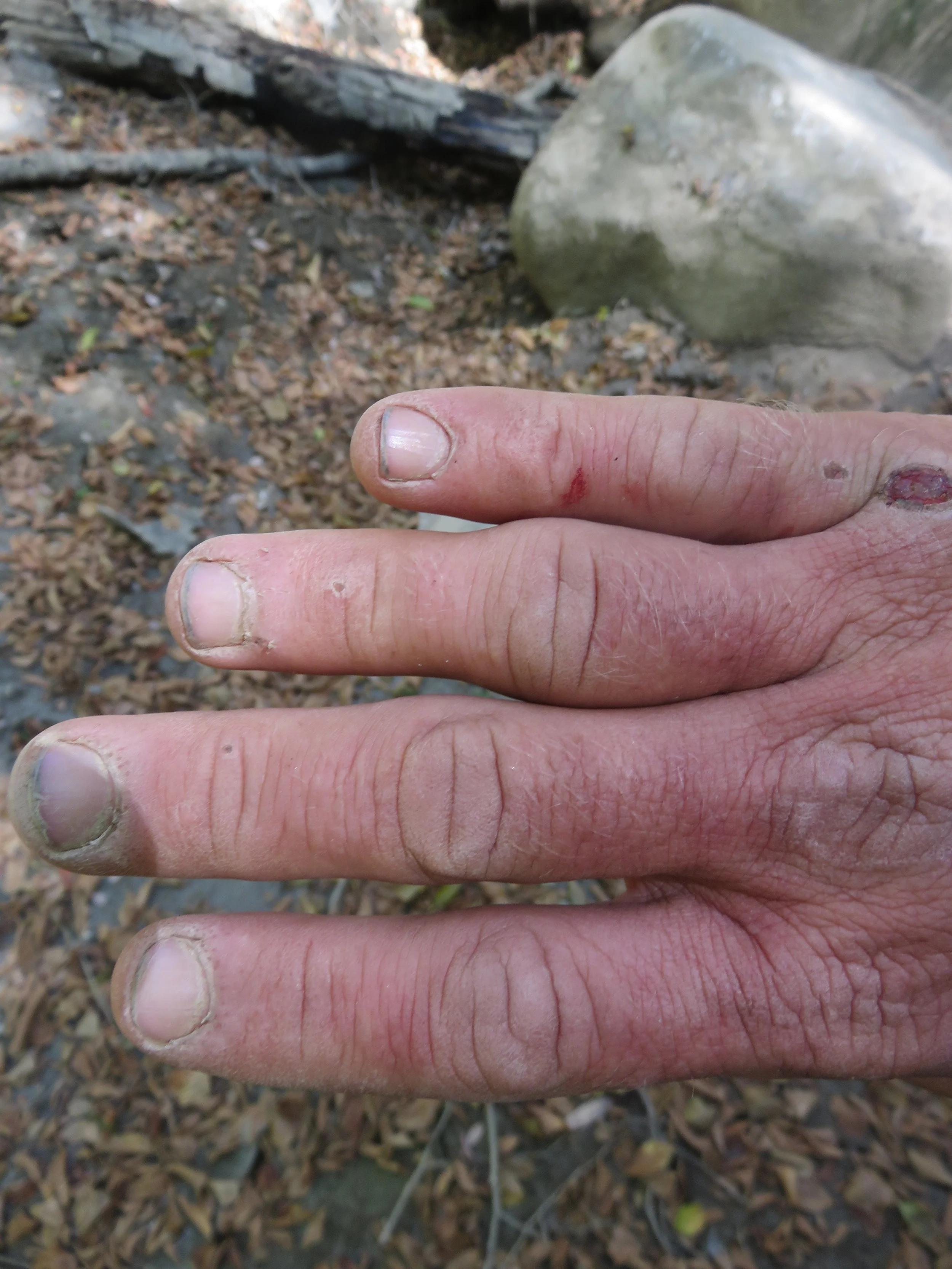 My beat up hand, and swollen knuckle, just after I relieved the dislocation.