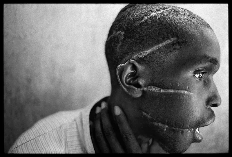 James Nachtwey, A Hutu man at a Red Cross hospital in Nyanza, Rwanda, 1994 Placements: PEITO & ABD | COSTAS & GLÚTEOS |