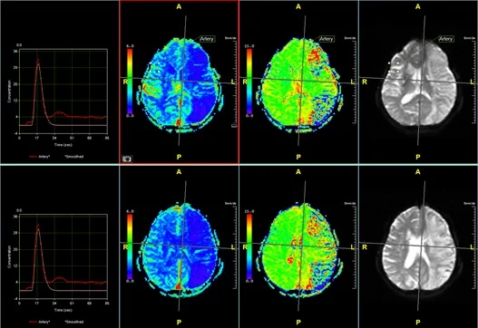 1-5-MR-perfusion.jpg