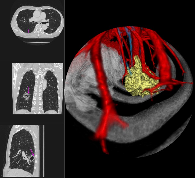 2-2-bronchus5.jpg