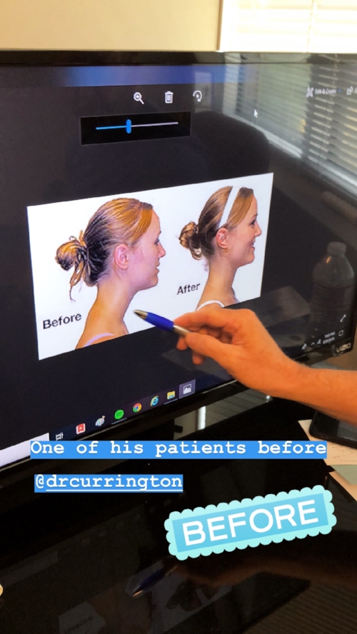 One of Dr. Mark Currington’s Patient before and after spine correction