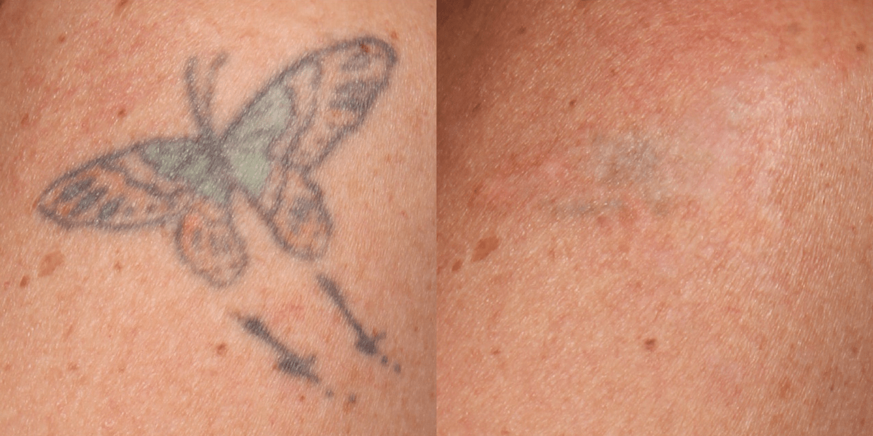 pico sure B&A 1.png