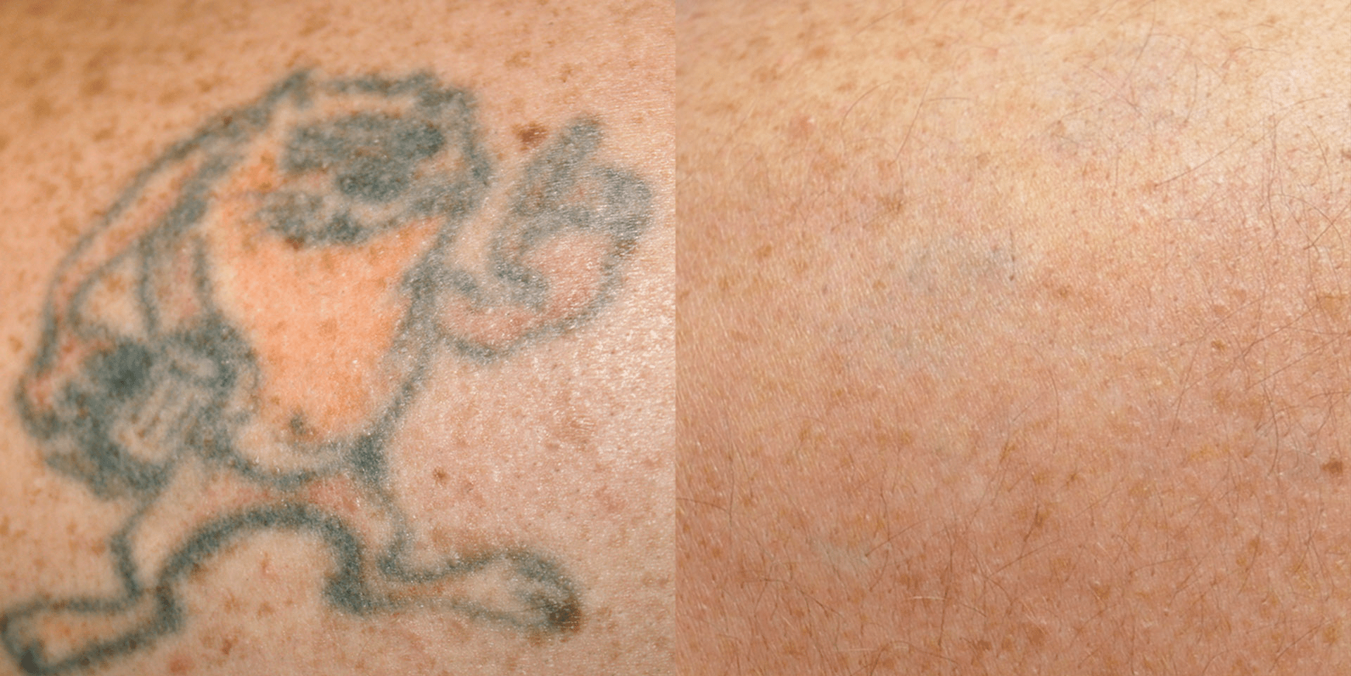 Before and After PicoSure Laser