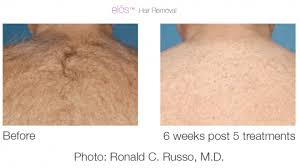 Discover more than 144 elos hair removal super hot