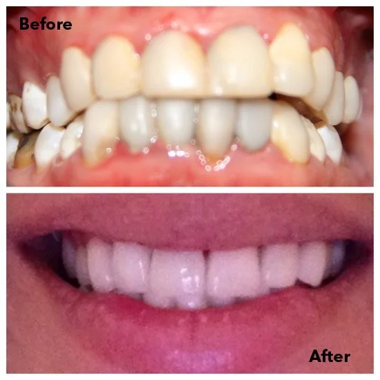 Before & After Gallery — Sorrento Valley Smiles Dental Practice - Dr ...