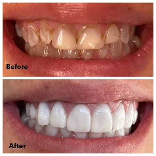 Before & After Gallery — Sorrento Valley Smiles Dental Practice - Dr ...
