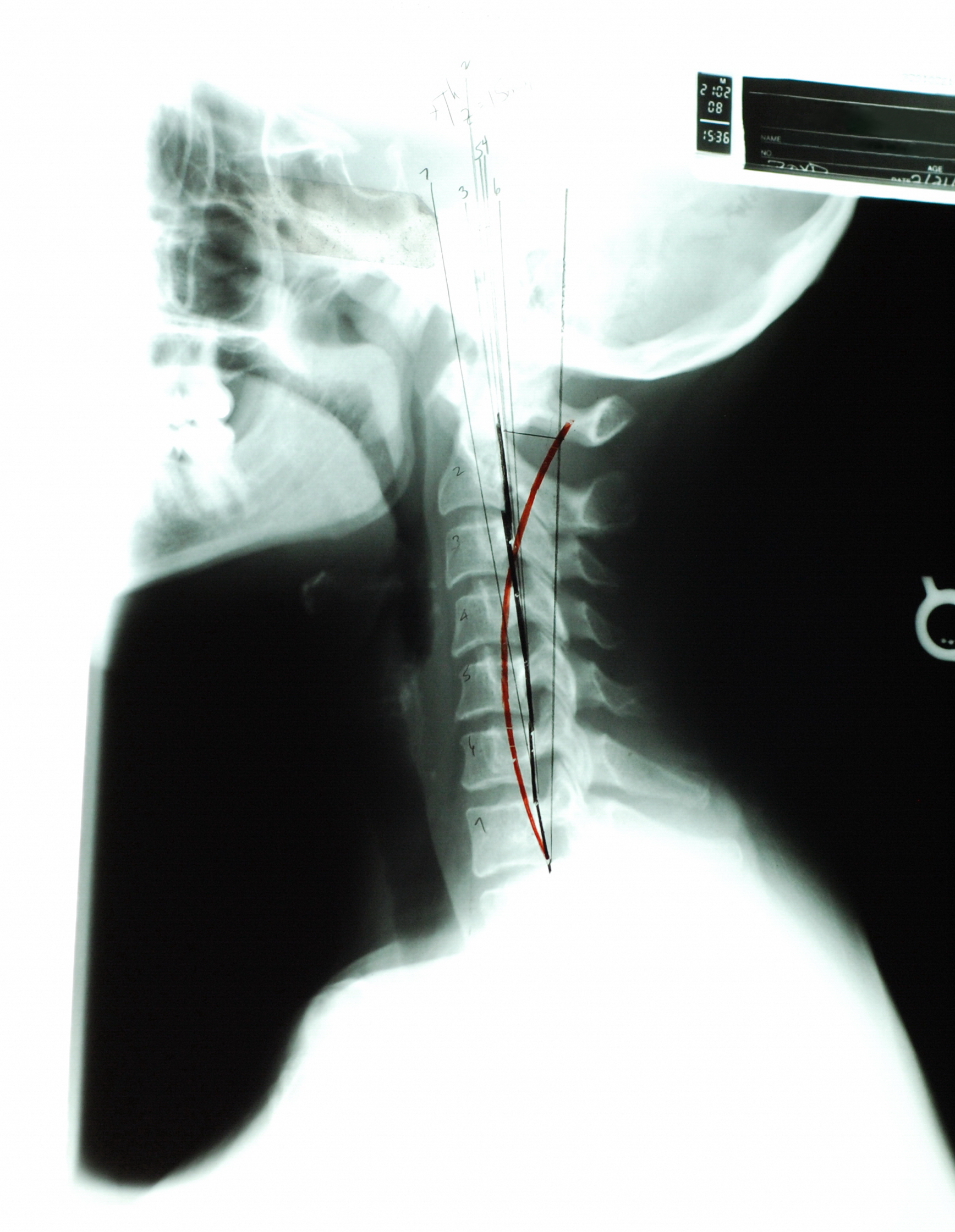 Thousands of pounds of force are exerted upon the neck and spine of the whiplash victim. 