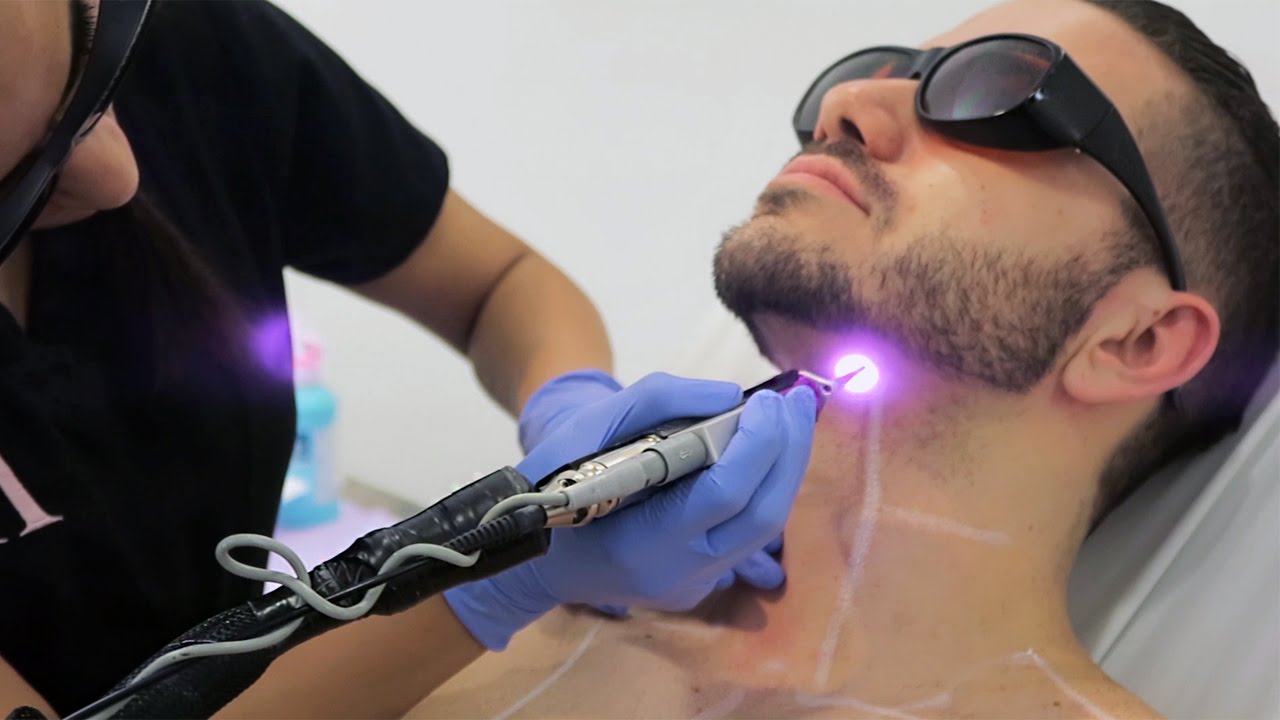 Facial Hair Removal For Men