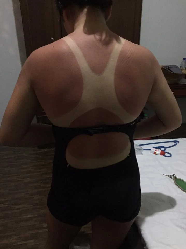 6 months later and the sunburns are still visible