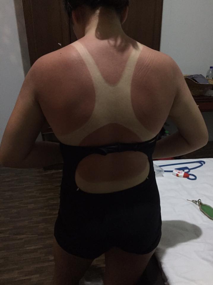 6 months later and the sunburns are still visible