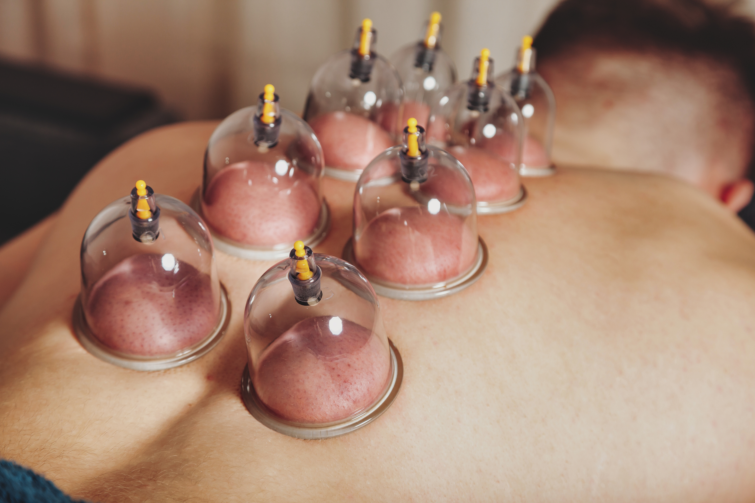 Recover Faster with Cupping Therapy!