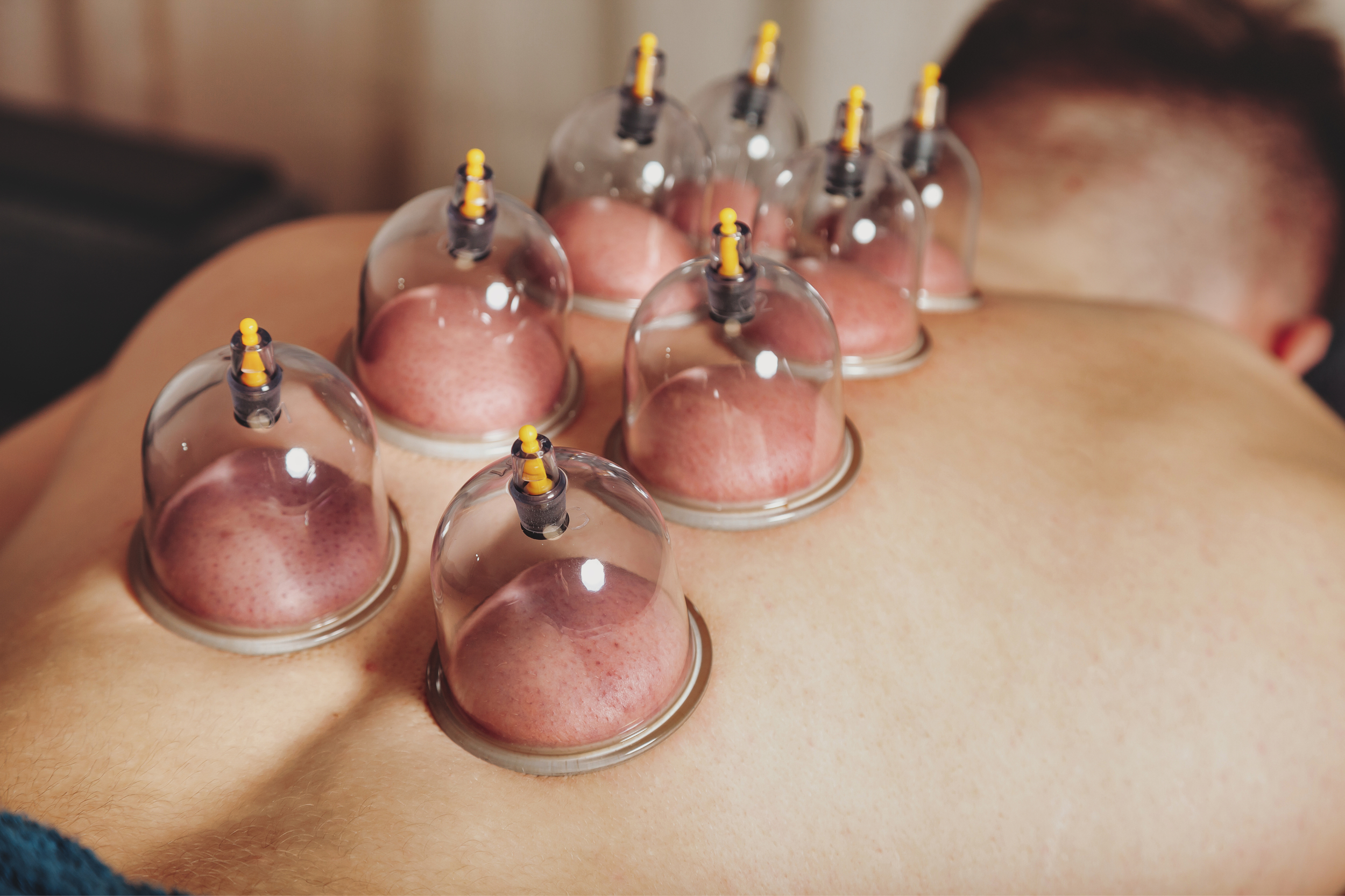 Cupping Therapy Explained: Ancient Practice, Modern Benefits