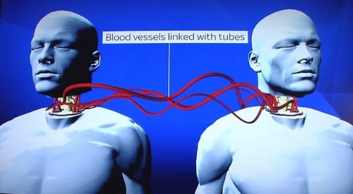 First Human Head Transplant Scheduled For December 2017