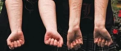 AUTOLESIONES: EL DOLOR FÍSICO MITIGA EL DOLOR PSICOLÓGICO