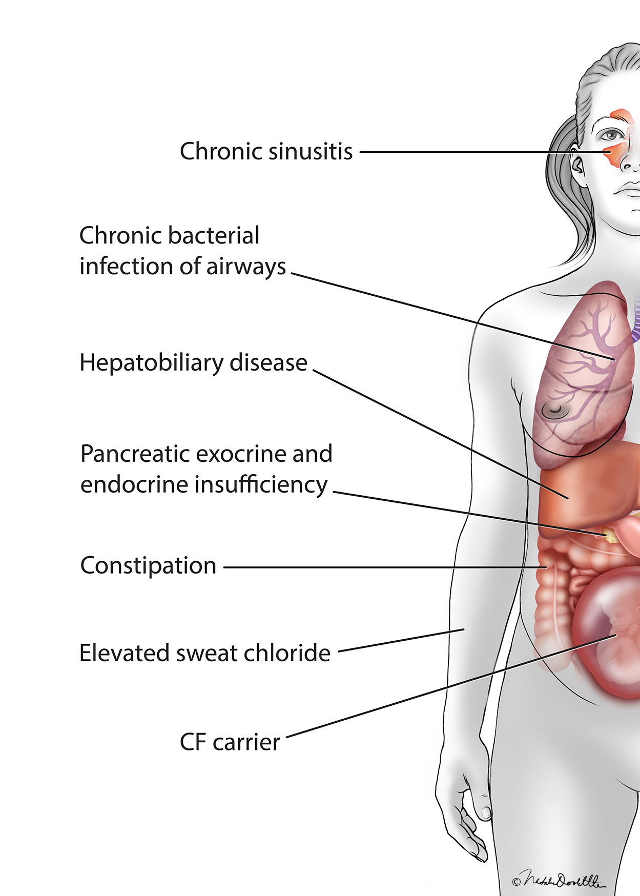 Cystic Fibrosis Complications