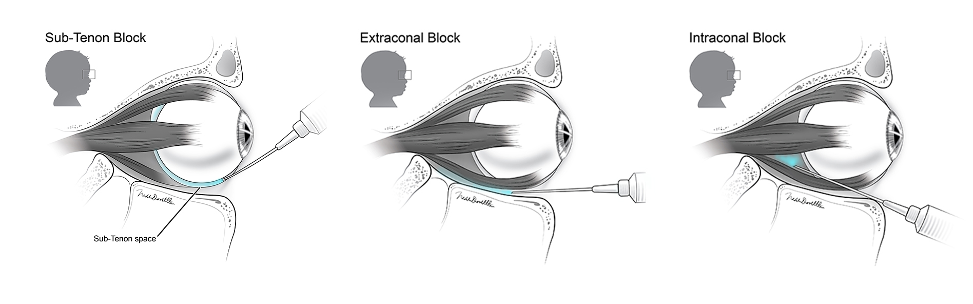 Anesthesia Blocks