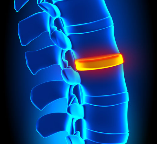 Back-Pain-Disc-Small.jpg