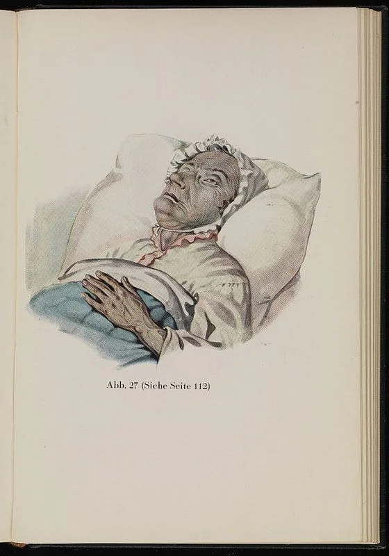 Холера. Сандхаас