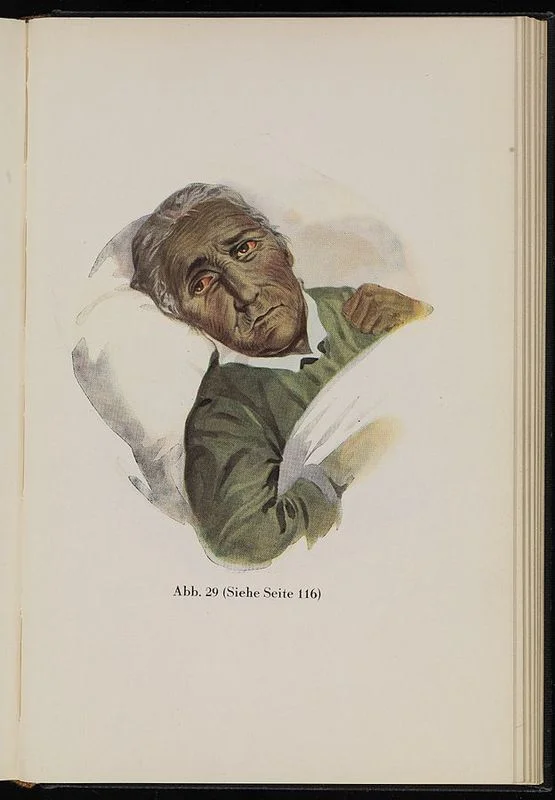 Черная желтуха. Сандхаас