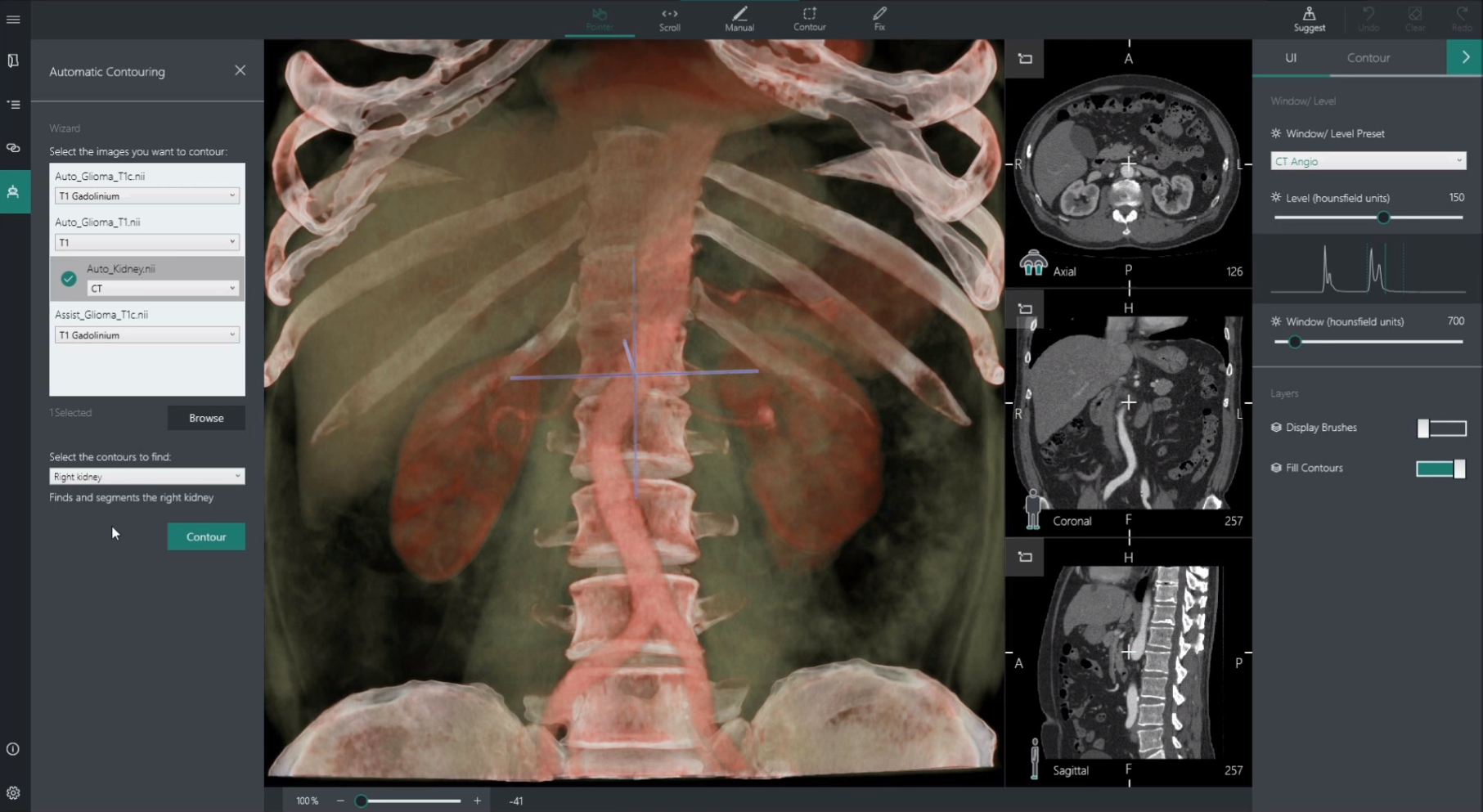 Диагностика рака за 30 секунд от Microsoft