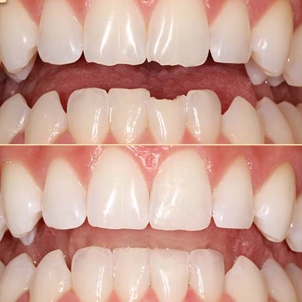 Temporary Tooth Filling May Only Be A Short Term Fix - Smile Studio NC -  Cosmetic & Family Dentist