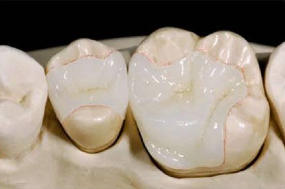porcelain-onlay.jpg