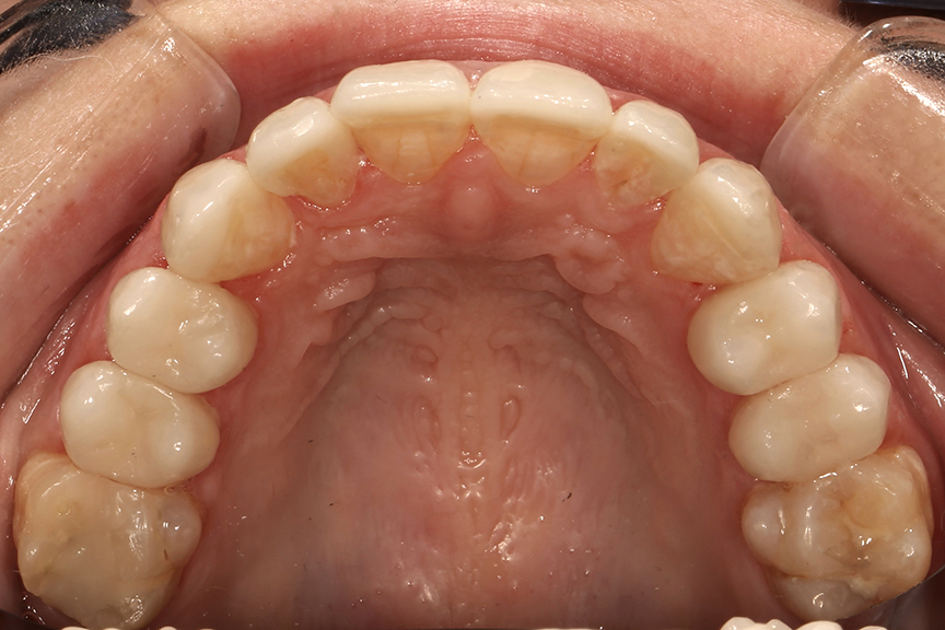 Final restorations in mouth