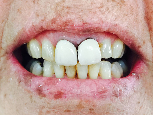 Patient unhappy with old crowns that didn't match other teeth