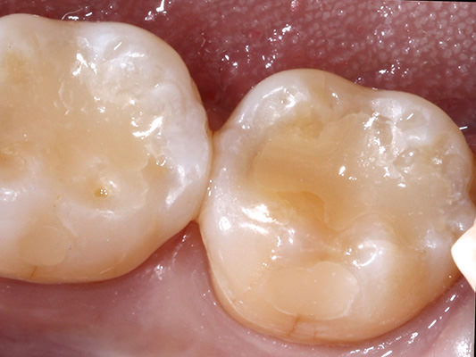 Removed decay and replaced with new tooth-colored fillings