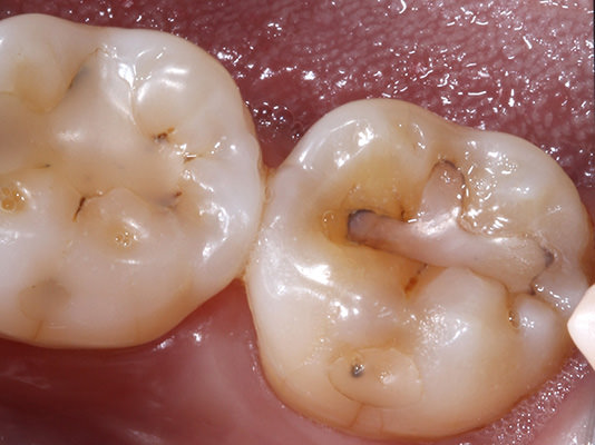 Old fillings with leakage and recurrent decay