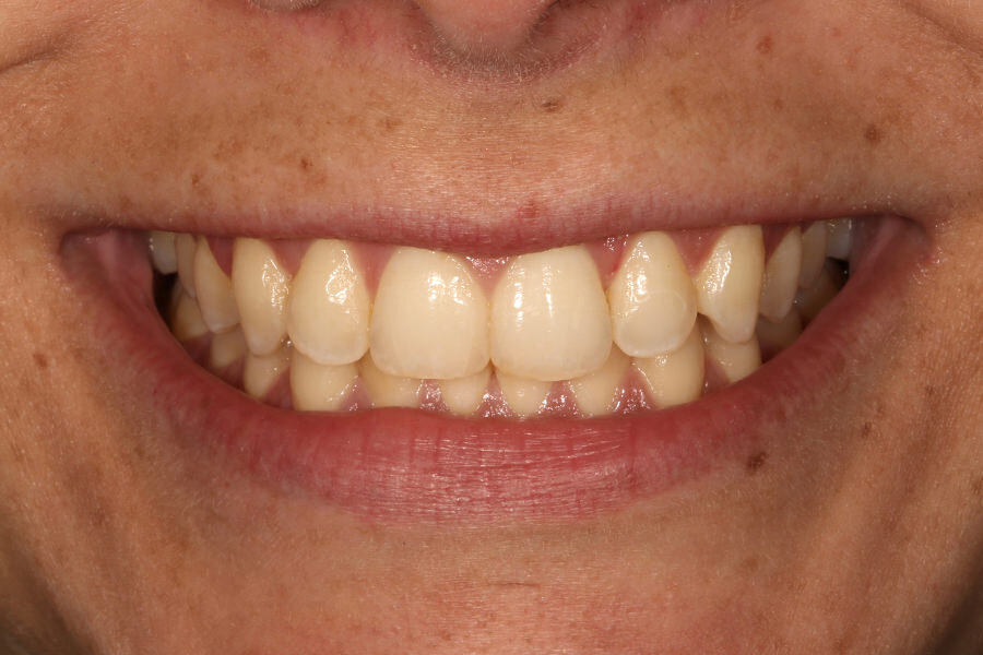 Patient unhappy with shape of natural teeth