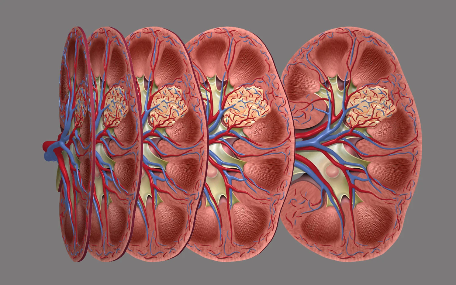Renal Carcinoma