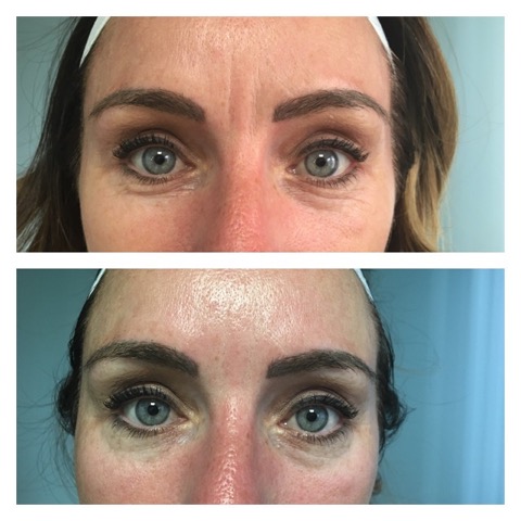 Thermalift Treatment Between Eyes and Forehead