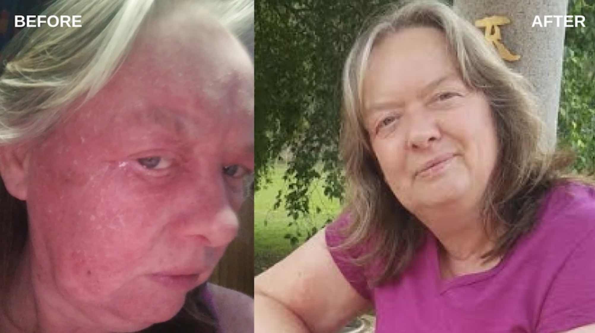 Julie Lowe healed her skin condition and lowered her cholesterol on the I Feel Good Program.jpg