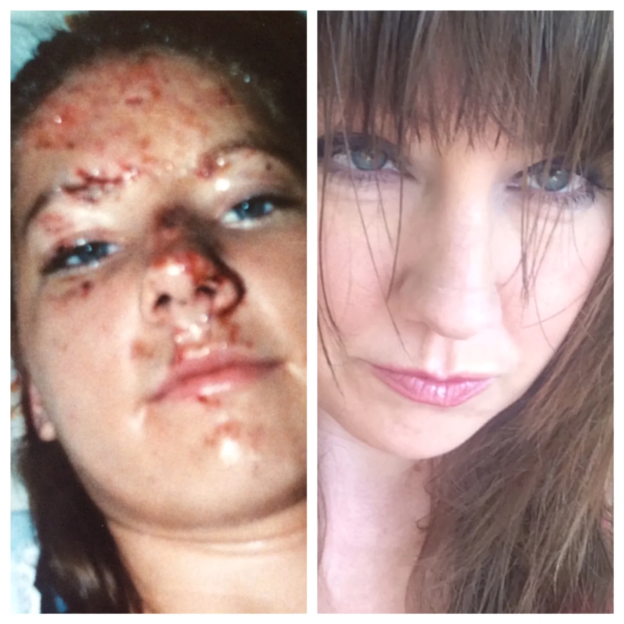 My own wound healing experience