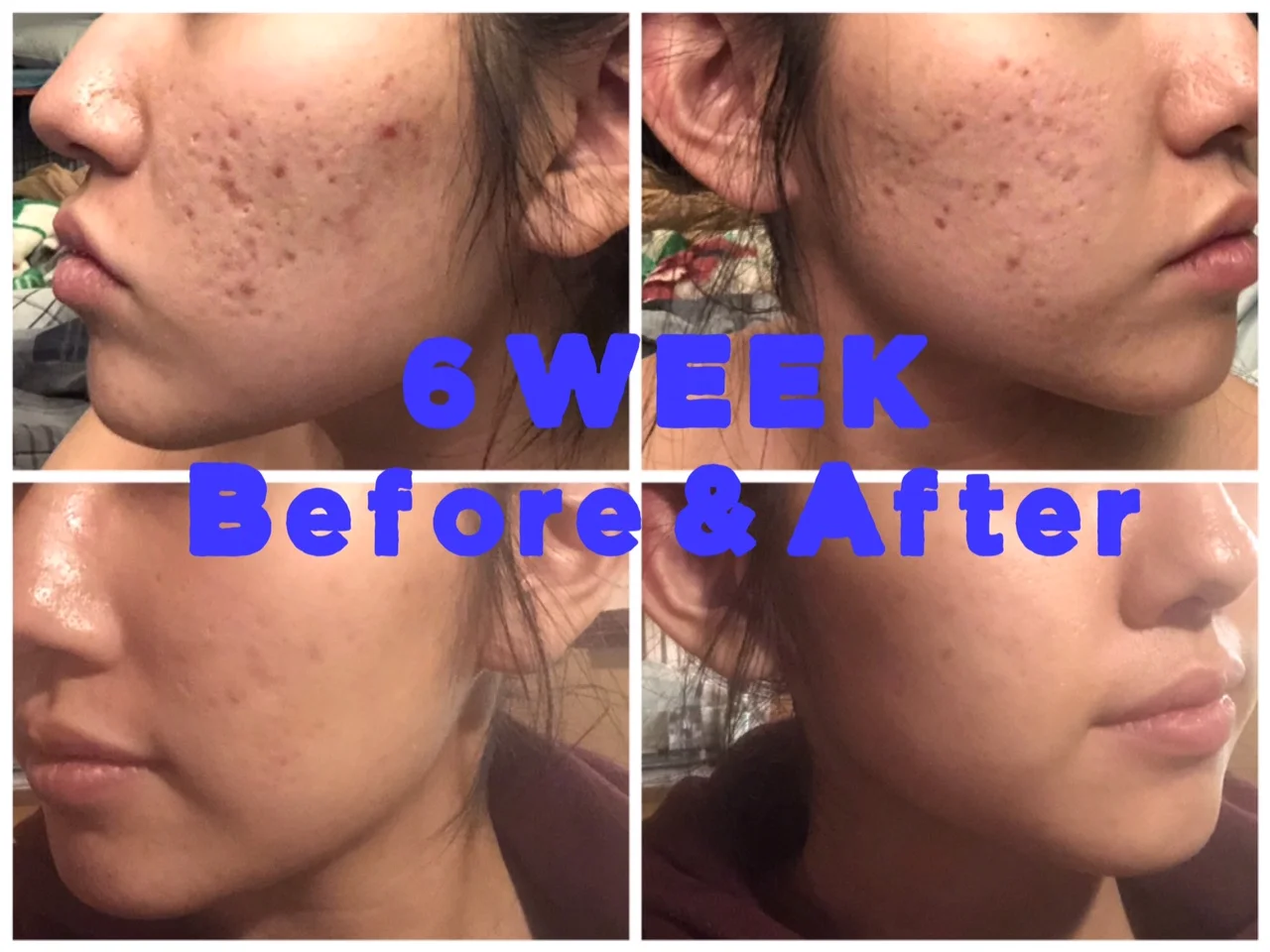 Acne Scars: Before, After, Testimonial