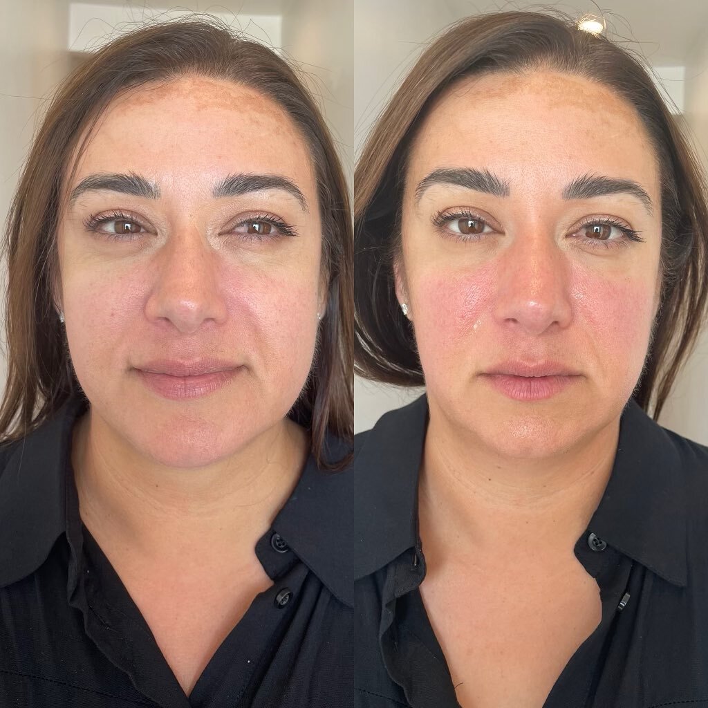 Pre and Post RFL / Buccal treatment performed on ALTH owner @crystal_althspa done by the incredibly skilled @estheticsby_lydia. 

✨This treatment is a revolutionary noninvasive beauty secret that sculpts, tones and lifts the facial muscles to reveal 