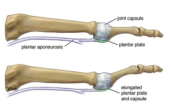 plantar_plate1