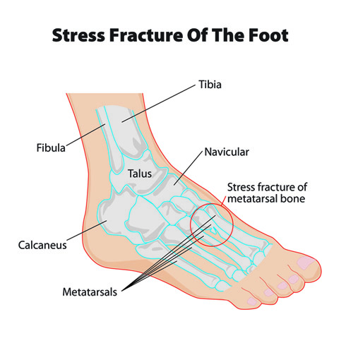 stress_fracture_feet.jpg